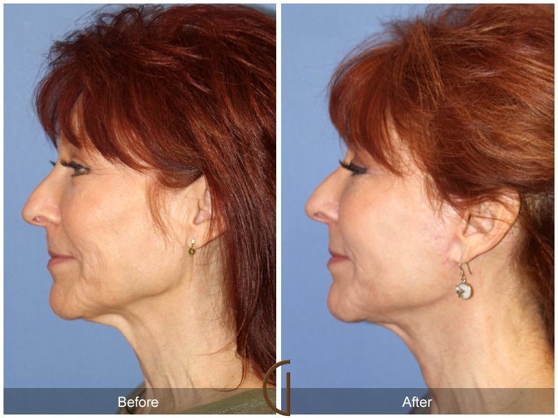 Female Facelift  Before & After Image