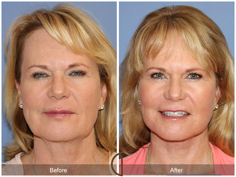 Female Facelift  Before & After Image