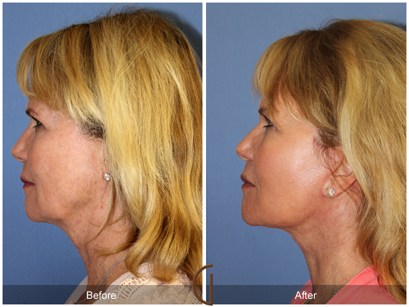 Female Facelift  Before & After Image