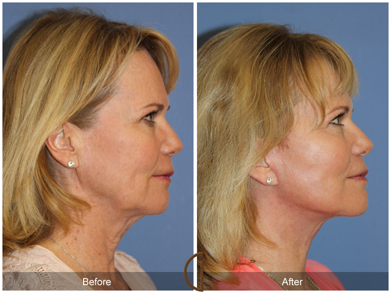 Female Facelift  Before & After Image