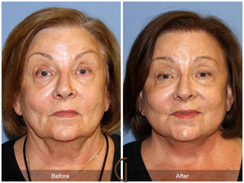 Female Facelift  Before & After Image