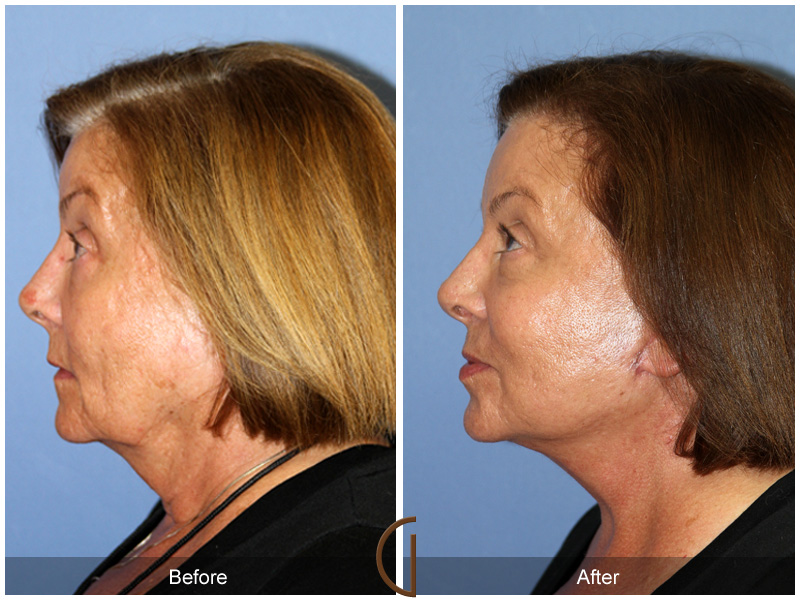 Female Facelift  Before & After Image