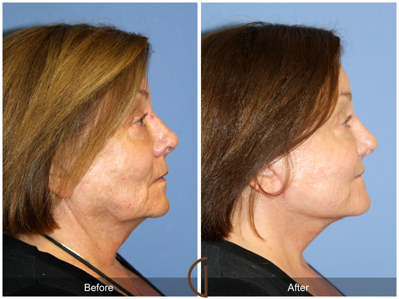 Female Facelift  Before & After Image