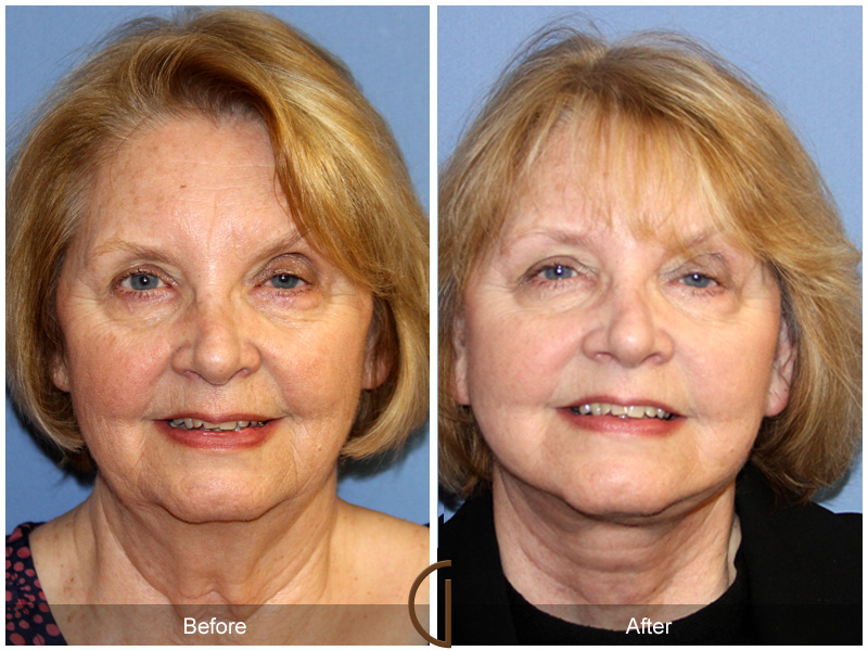 Female Facelift  Before & After Image