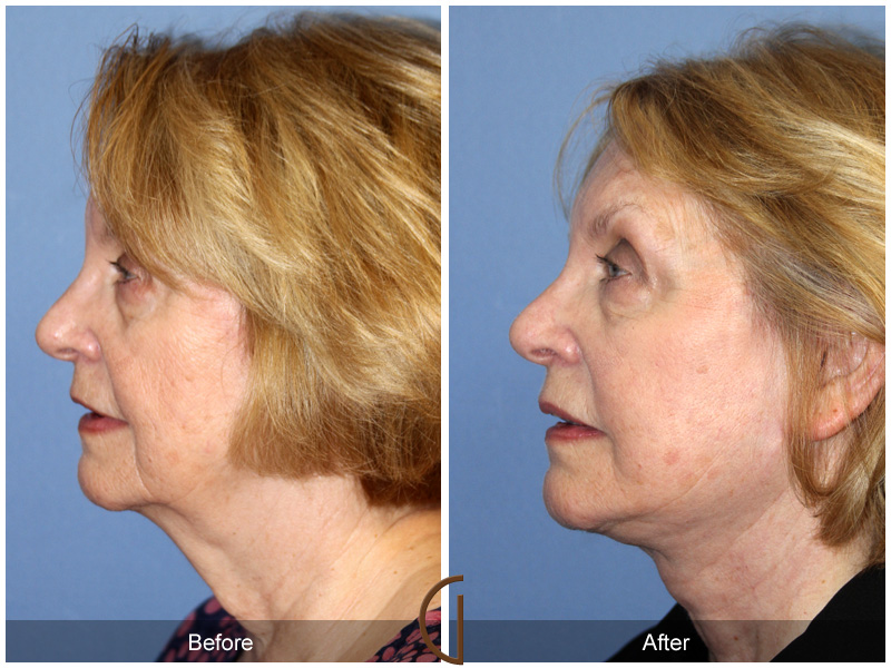 Female Facelift  Before & After Image