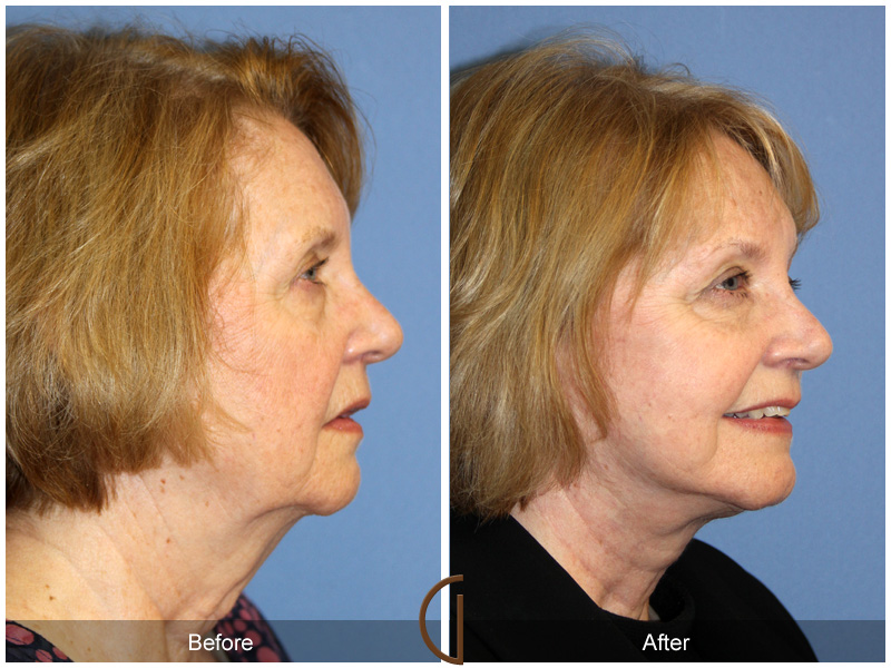 Female Facelift  Before & After Image