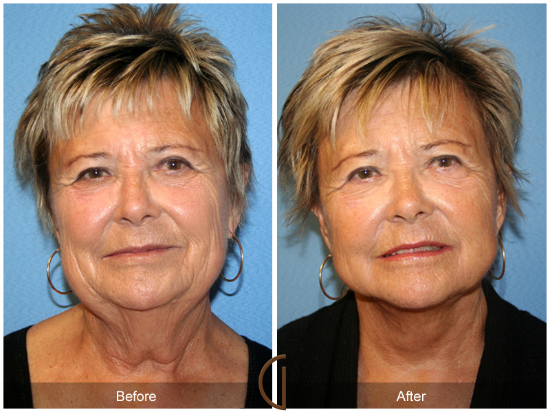 Female Facelift  Before & After Image