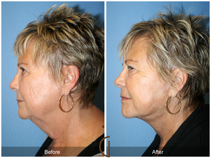 Female Facelift  Before & After Image