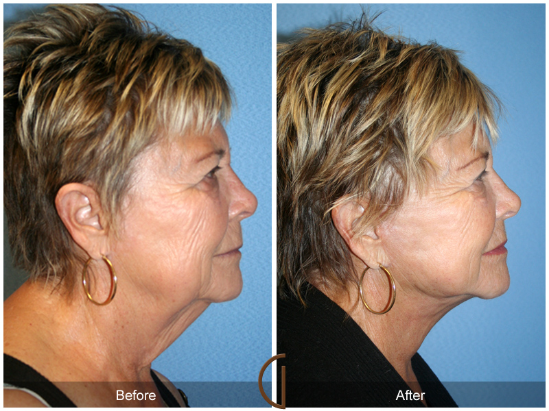 Female Facelift  Before & After Image