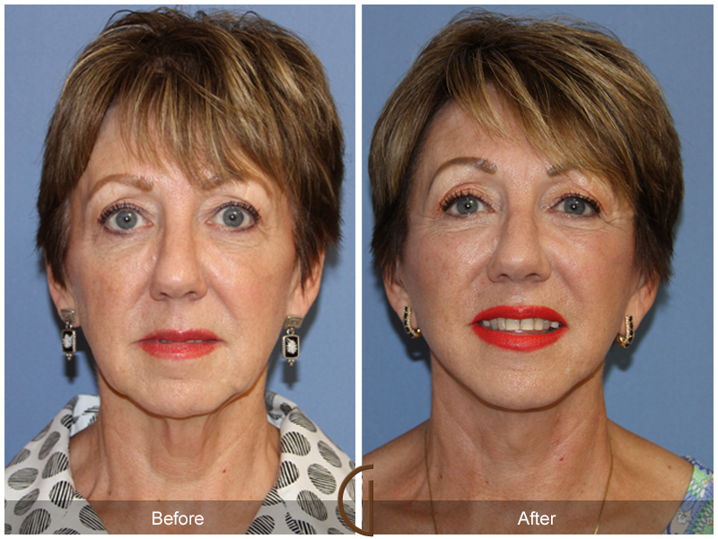 Female Facelift  Before & After Image