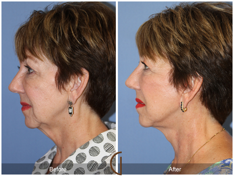 Female Facelift  Before & After Image