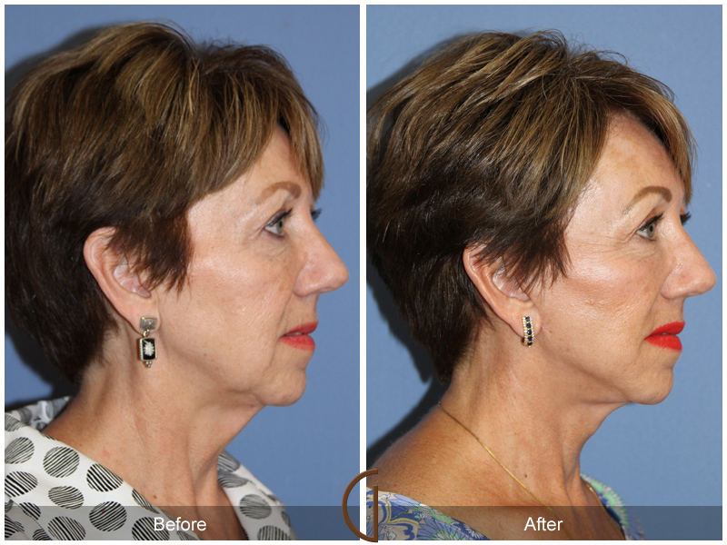 Female Facelift  Before & After Image