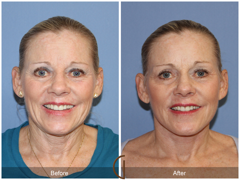 Female Facelift  Before & After Image