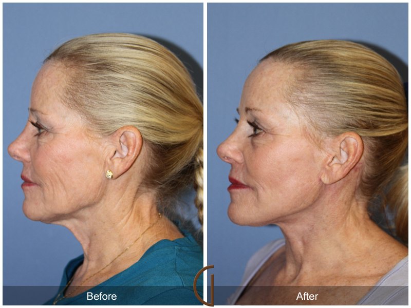 Female Facelift  Before & After Image