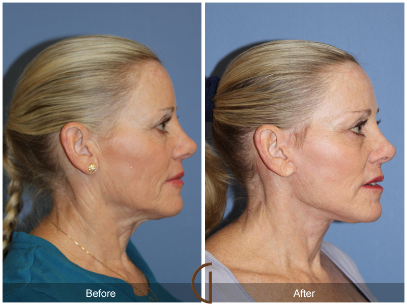 Female Facelift  Before & After Image