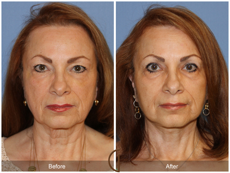 Female Facelift  Before & After Image