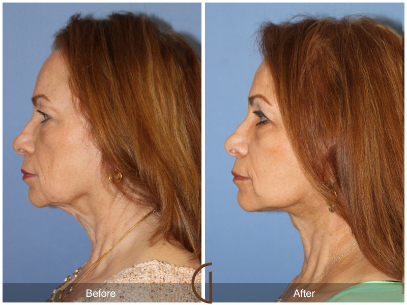 Female Facelift  Before & After Image