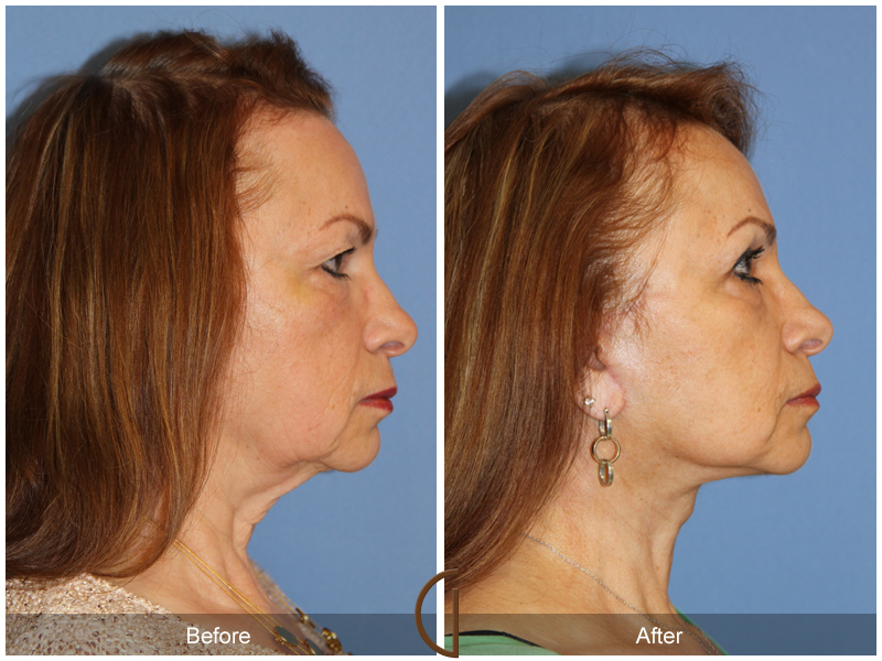 Female Facelift  Before & After Image