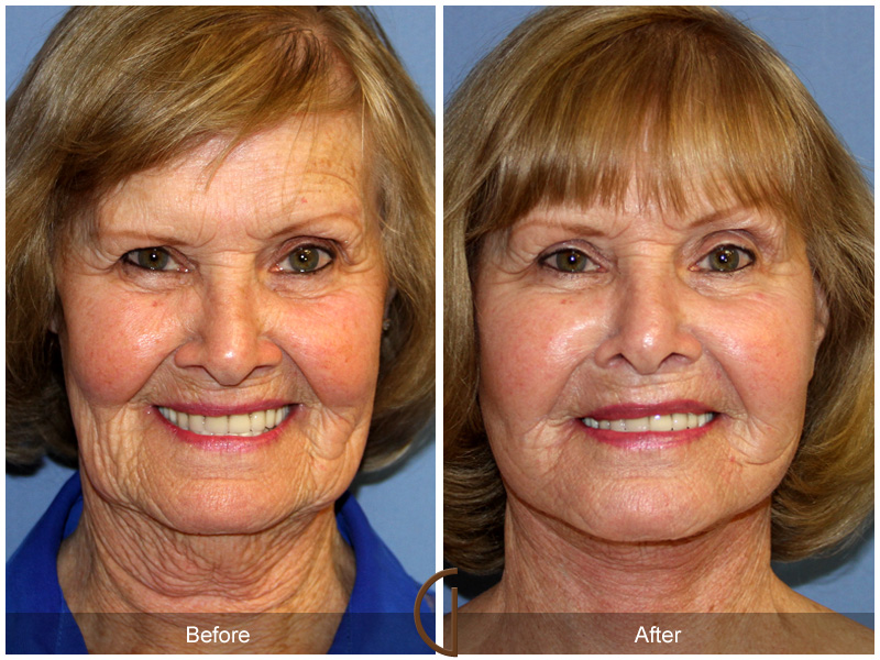 Female Facelift  Before & After Image