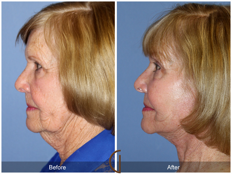 Female Facelift  Before & After Image