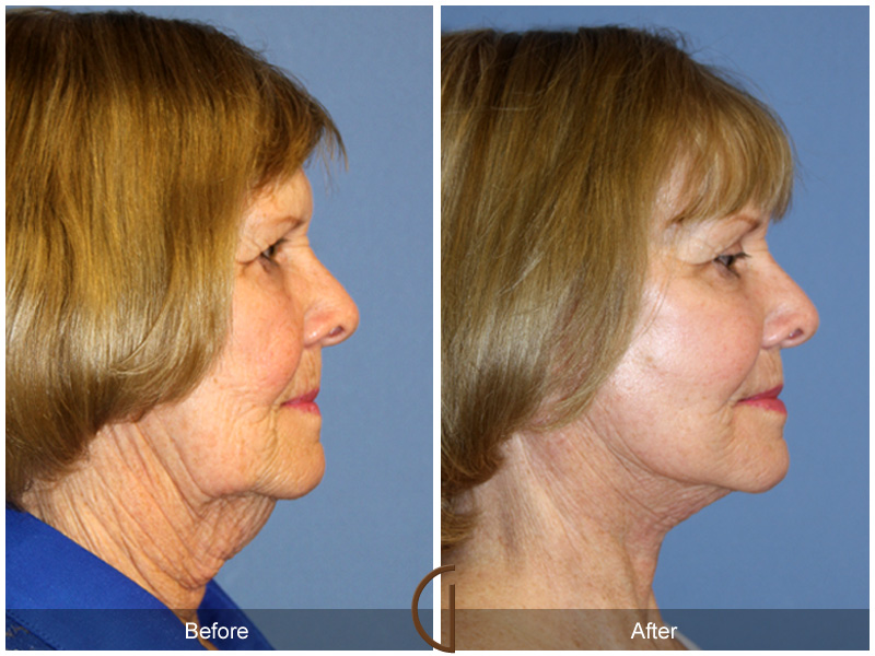 Female Facelift  Before & After Image