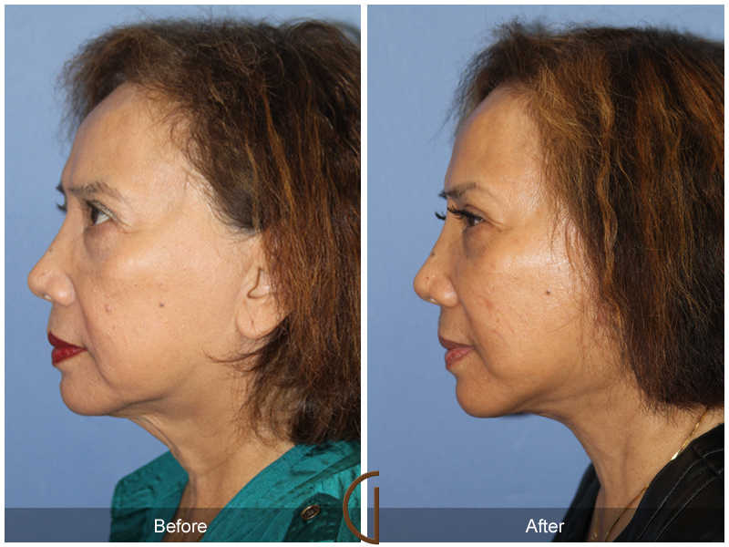 Female Facelift  Before & After Image