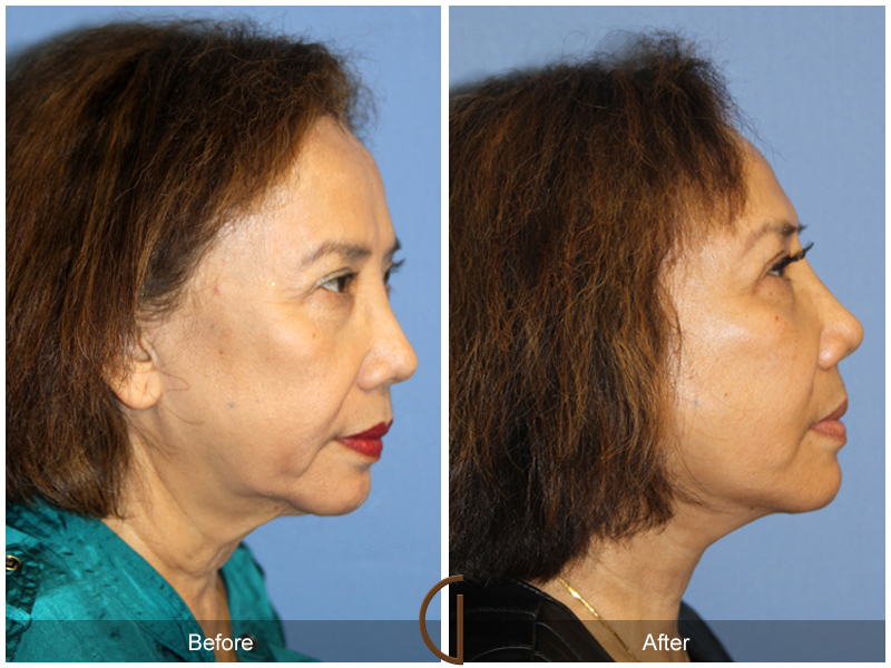 Female Facelift  Before & After Image