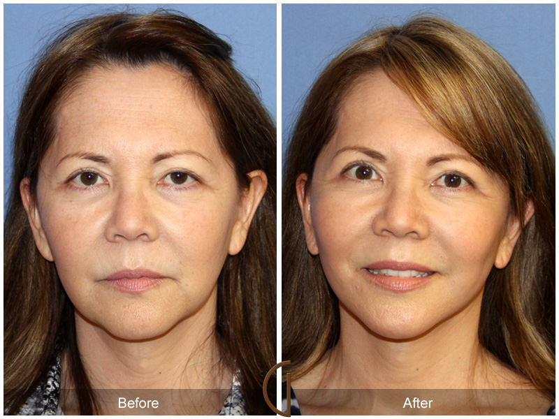 Female Facelift  Before & After Image