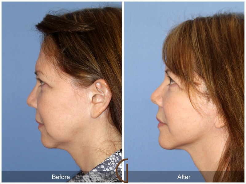 Female Facelift  Before & After Image