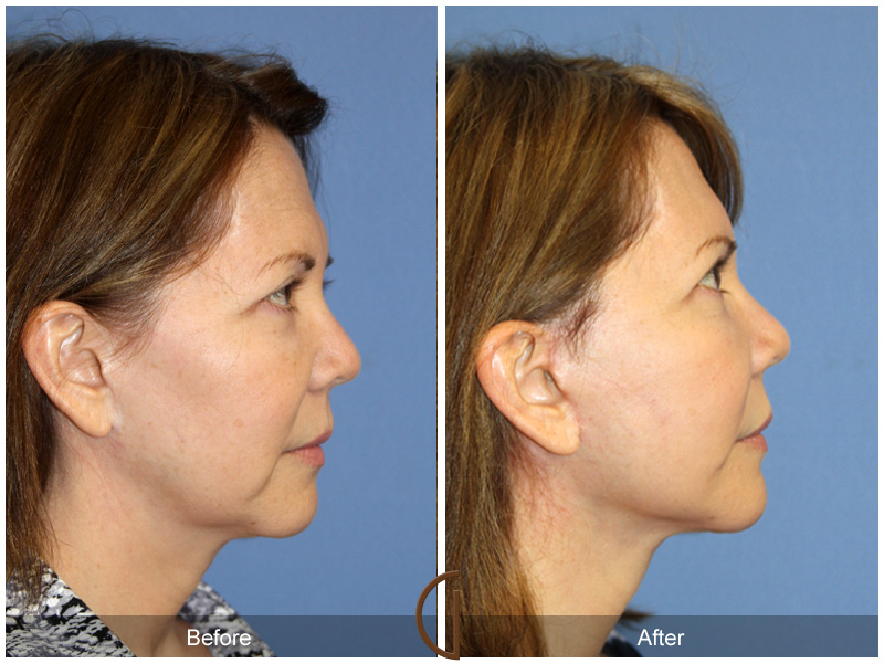 Female Facelift  Before & After Image