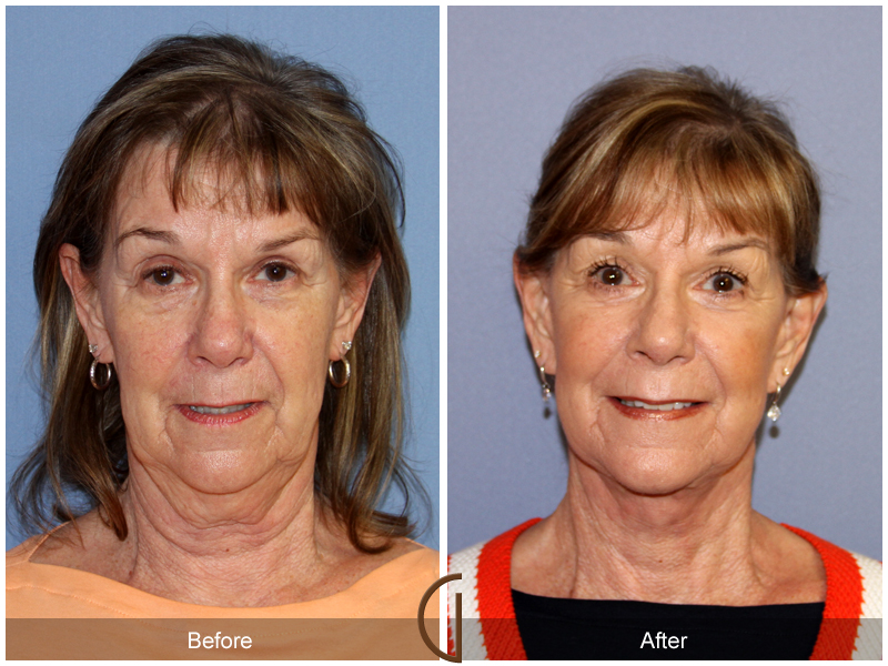 Female Facelift  Before & After Image