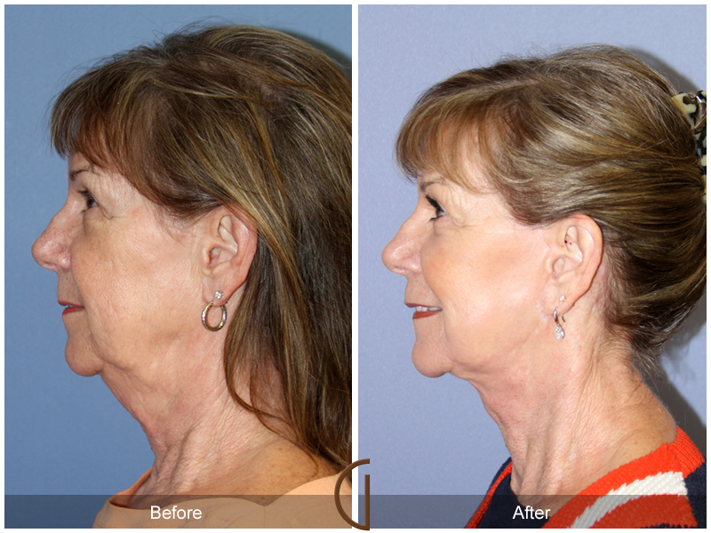 Female Facelift  Before & After Image