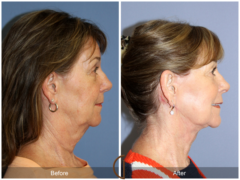 Female Facelift  Before & After Image