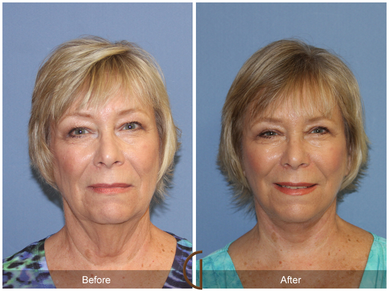 Female Facelift  Before & After Image