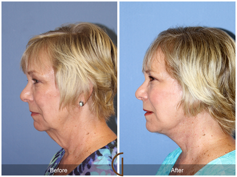 Female Facelift  Before & After Image