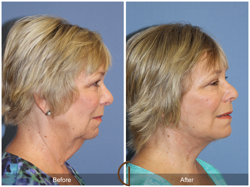 Female Facelift  Before & After Image