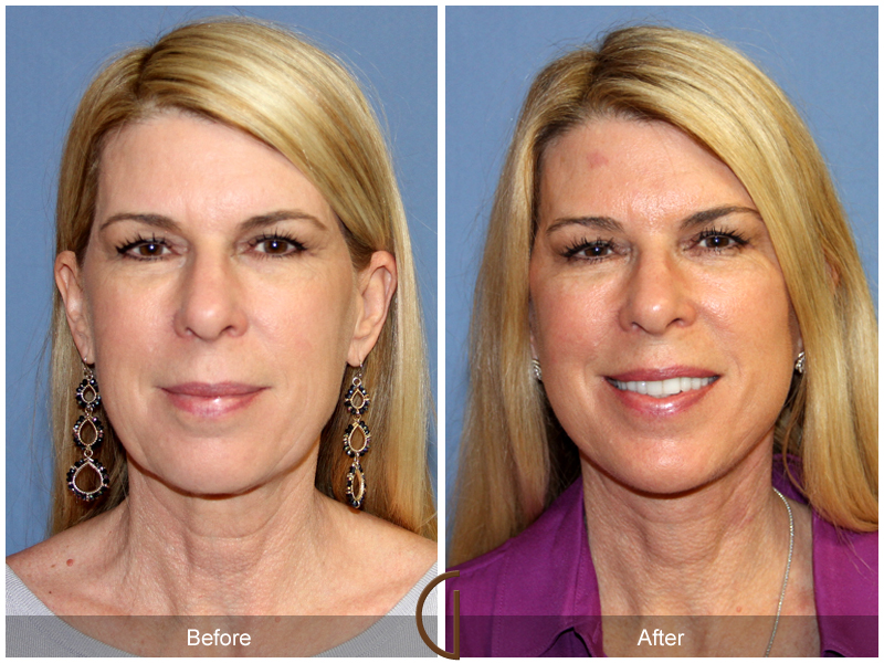 Female Facelift  Before & After Image