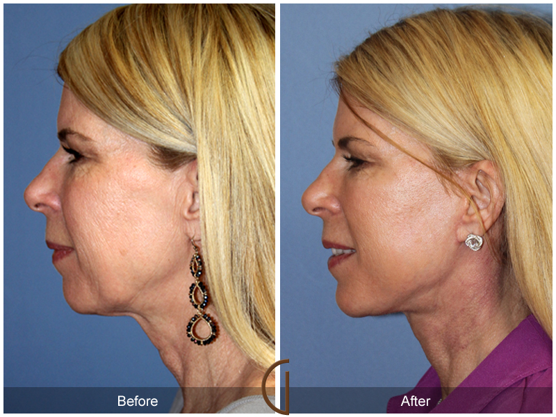 Female Facelift  Before & After Image