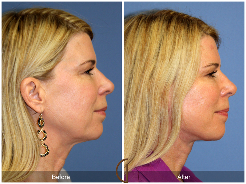 Female Facelift  Before & After Image