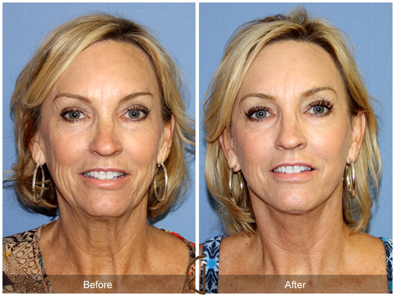 Female Facelift  Before & After Image