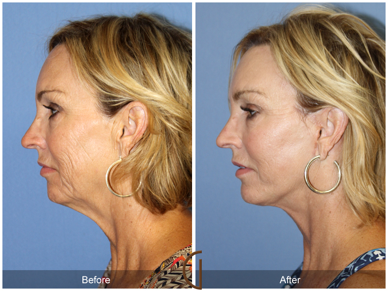 Female Facelift  Before & After Image