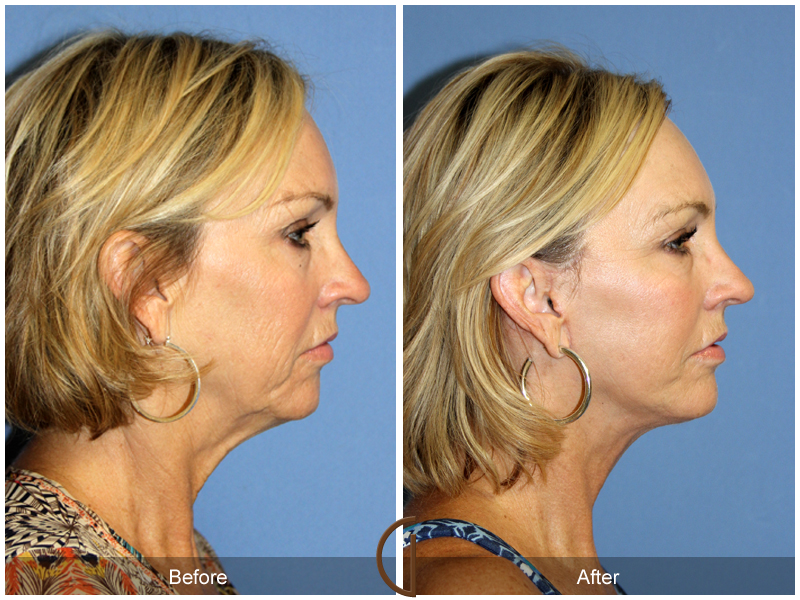 Female Facelift  Before & After Image