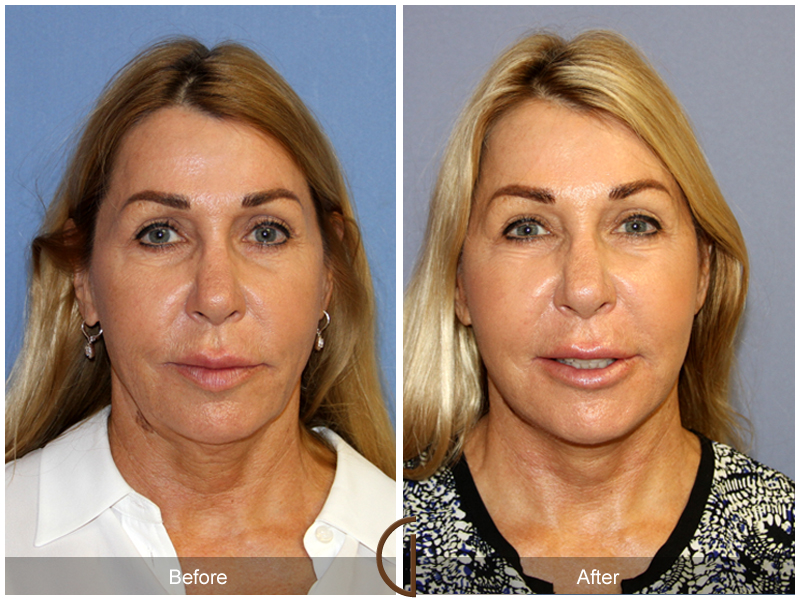 Female Facelift  Before & After Image