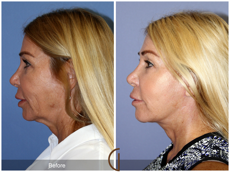 Female Facelift  Before & After Image