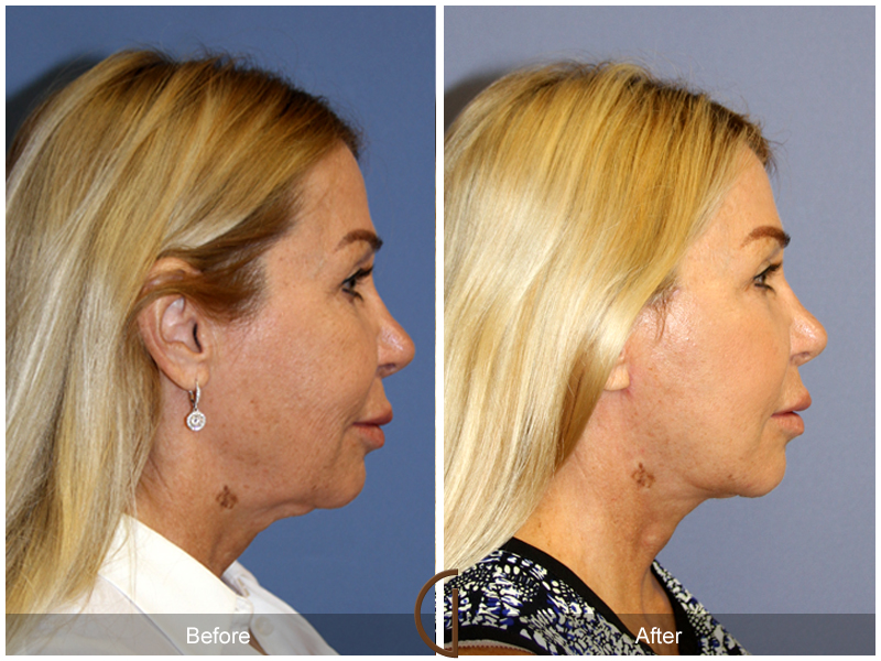 Female Facelift  Before & After Image