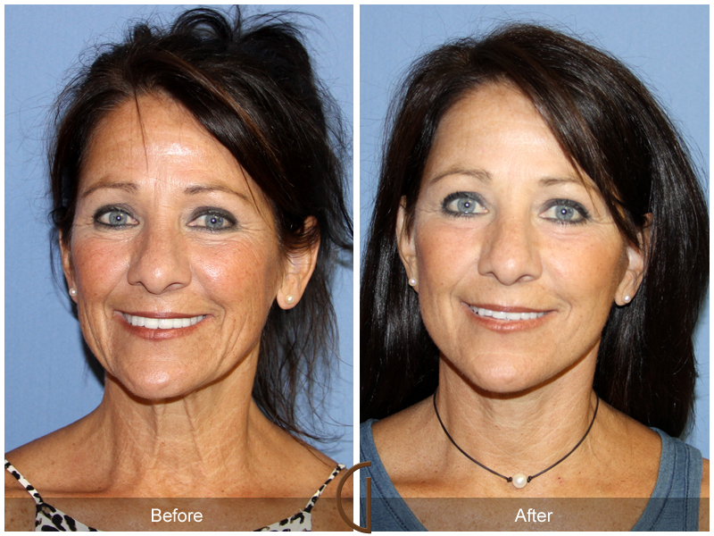 Female Facelift  Before & After Image