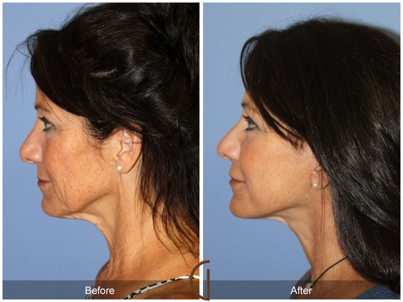 Female Facelift  Before & After Image