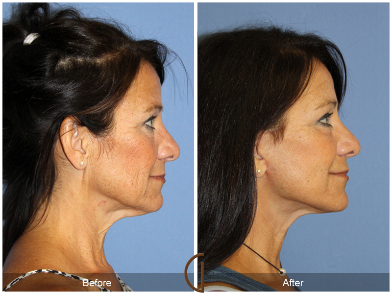 Female Facelift  Before & After Image