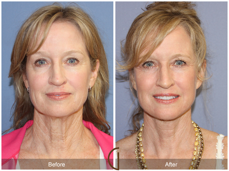 Female Facelift  Before & After Image