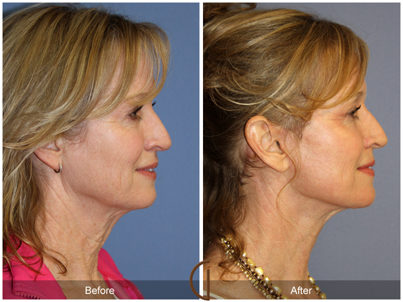 Female Facelift  Before & After Image